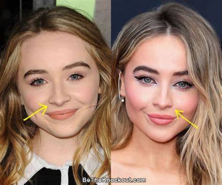 Unveiling The Truth: Has Sabrina Carpenter Gotten Plastic Surgery?